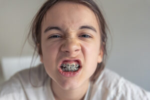 Braces for kids-Padiatric Dentist